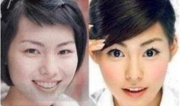 明星整形前后,整形前后对比，揭秘美丽背后的秘密